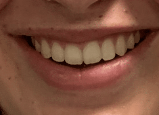 Efter - Dra i slidern för att se Novas resultat